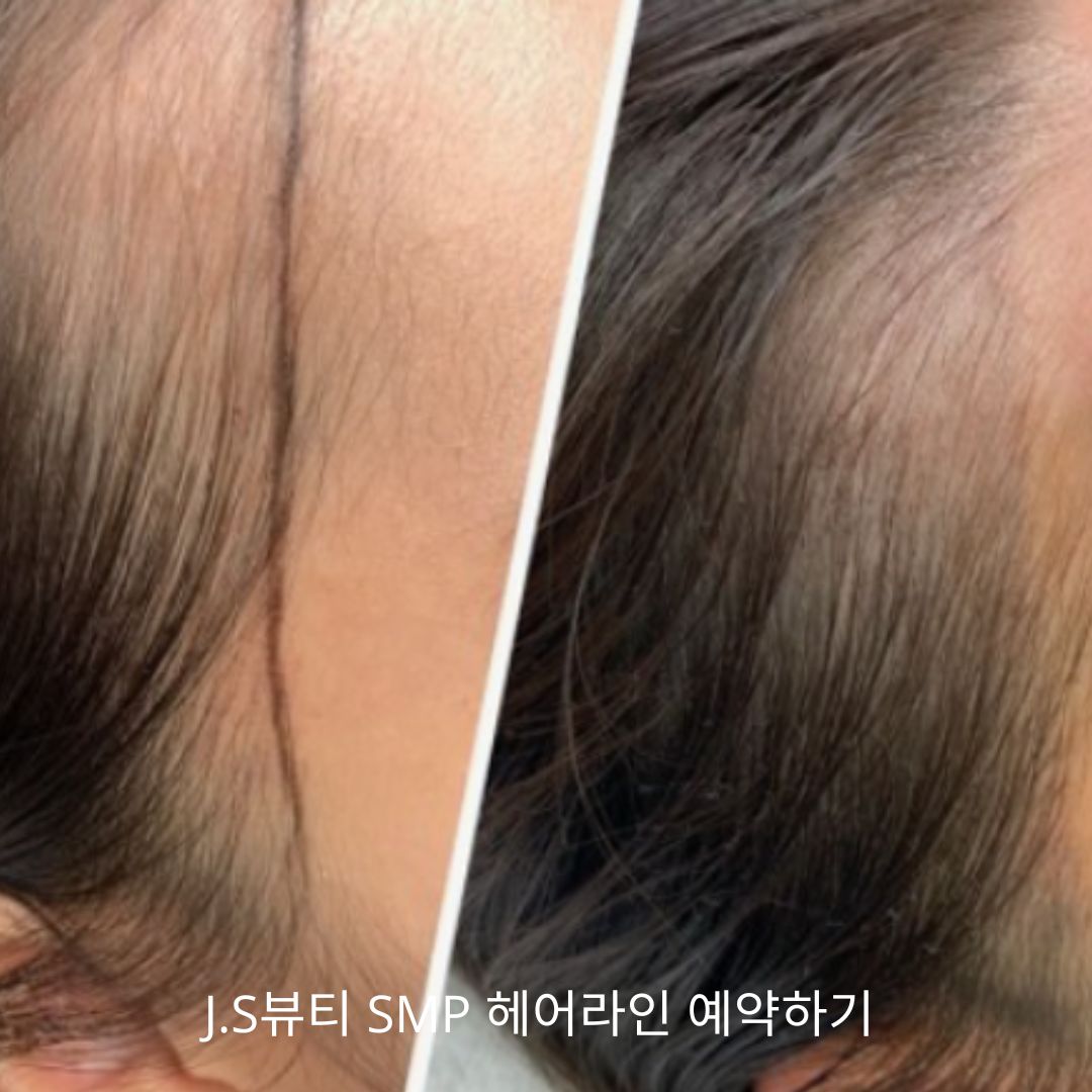 SMP헤어라인